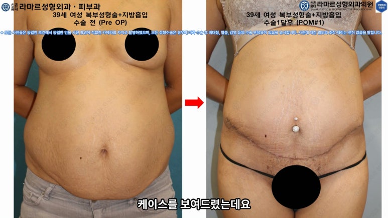 '복부성형술+지방흡입(Abdominoplasty+PAL)' 으로 뱃살 끝장내기! 관련 이미지 59