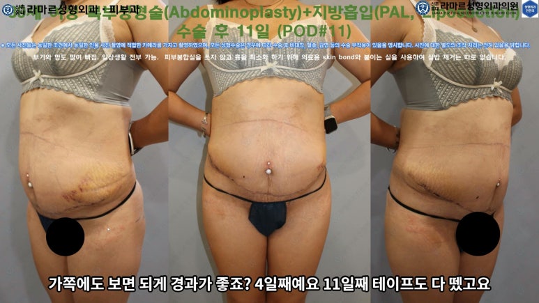'복부성형술+지방흡입(Abdominoplasty+PAL)' 으로 뱃살 끝장내기! 관련 이미지 44