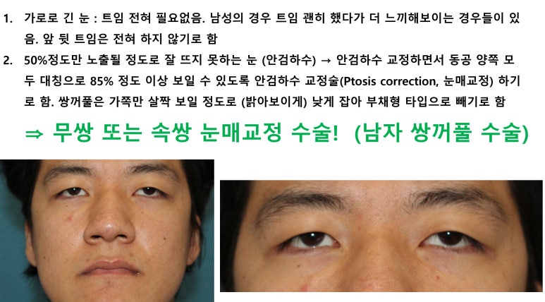 27세 남성 무쌍(속쌍)눈매교정 (27/M Ptosis correction with double lid plasty) 관련 이미지 3