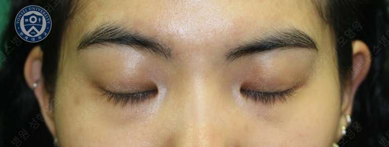 28세 여성, 눈밑지방재배치(눈밑지, 28/F Transconjunctival septal fat redraping-internal fixation technique) 관련 이미지 4