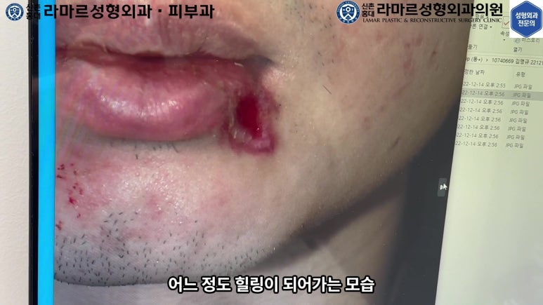 개에 물려 입술 1/3이 뜯긴 19세 남자분 치료 및 흉터 성형수술& 레이저 후기....! 관련 이미지 25