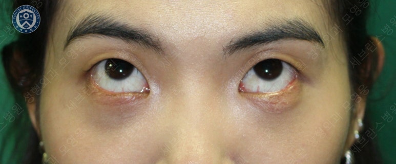 28세 여성, 눈밑지방재배치(눈밑지, 28/F Transconjunctival septal fat redraping-internal fixation technique) 관련 이미지 20