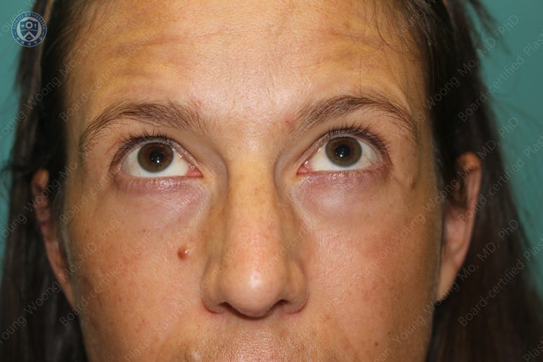 38세 서양 백인 여성, 쌍꺼풀 수술과 눈매교정 및 하안검성형술 (38/F Upper&lower blepharoplasty with levator plication) 관련 이미지 5
