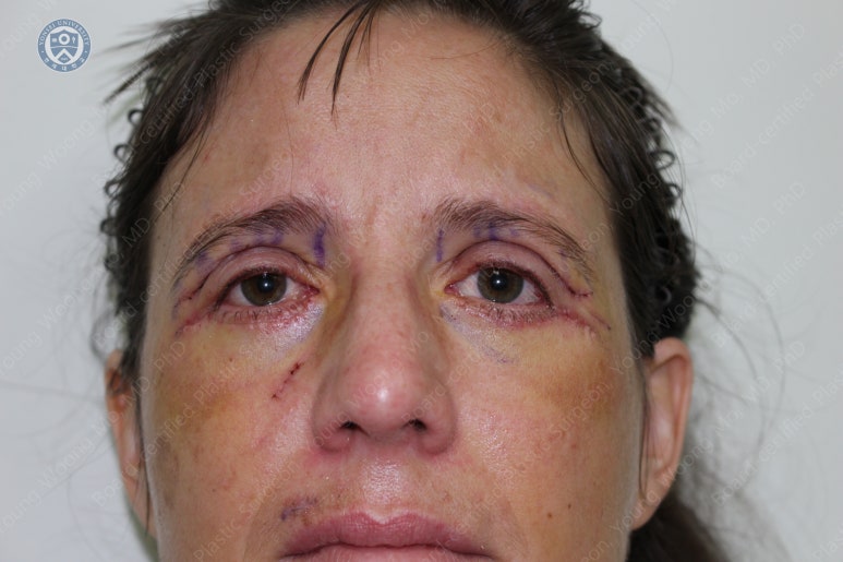 38세 서양 백인 여성, 쌍꺼풀 수술과 눈매교정 및 하안검성형술 (38/F Upper&lower blepharoplasty with levator plication) 관련 이미지 15
