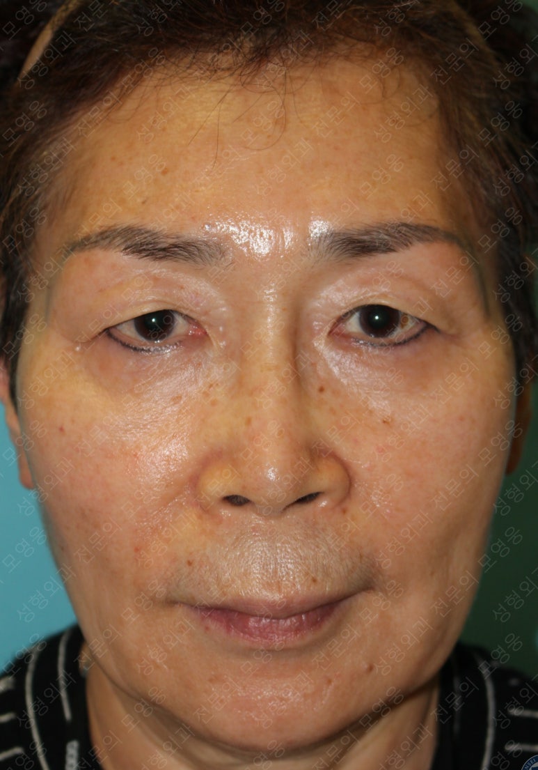 64세 여성 상안검성형술+눈매교정 (64/F Upper blepharoplasty with ptosis correction) 관련 이미지 2