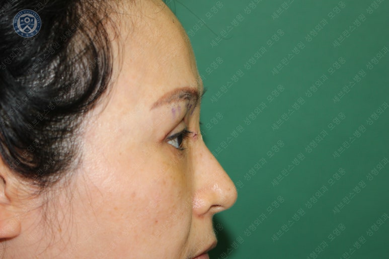 49세 여성, 토안이 있는 중년여성의 상안검성형술 (49/F, Upper blepharoplasty with lagophthalmos correction& LP) 관련 이미지 23