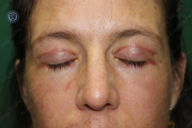 38세 서양 백인 여성, 쌍꺼풀 수술과 눈매교정 및 하안검성형술 (38/F Upper&lower blepharoplasty with levator plication) 관련 이미지 31