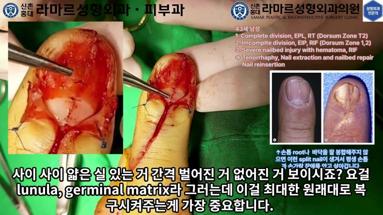 손가락 힘줄 손상 및 열상, 손톱 바닥 열상 처치 (Extensor tendon repair and nailbed injury treatment) 관련 이미지 27
