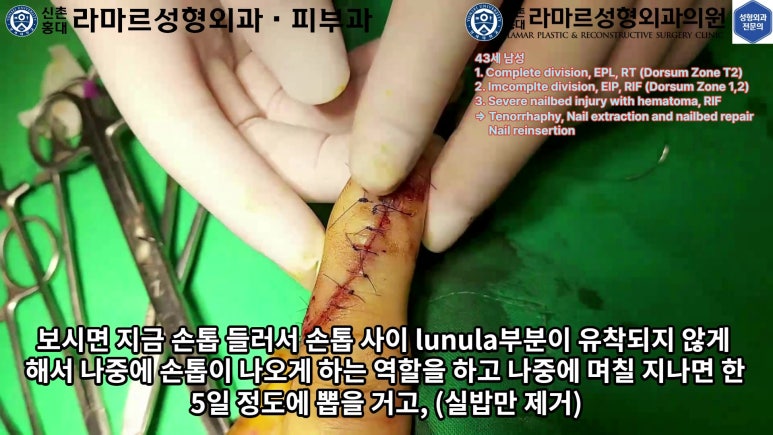 손가락 힘줄 손상 및 열상, 손톱 바닥 열상 처치 (Extensor tendon repair and nailbed injury treatment) 관련 이미지 30