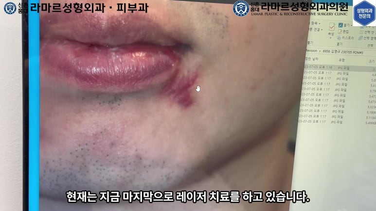개에 물려 입술 1/3이 뜯긴 19세 남자분 치료 및 흉터 성형수술& 레이저 후기....! 관련 이미지 45