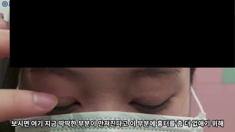 매몰 쌍꺼풀 풀고 절개쌍꺼풀로 바꾸는 쌍꺼풀 재수술!! 관련 이미지 75