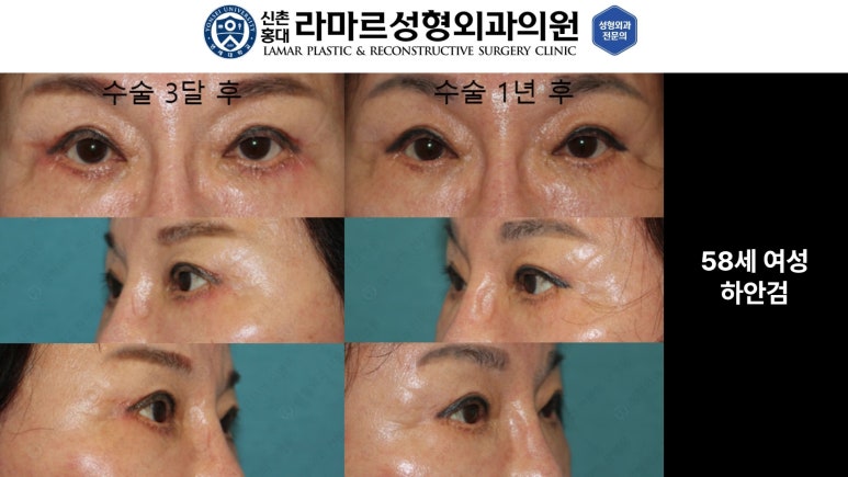 30대~80대 눈 수술 케이스 : 하안검성형술 전후 사진 모음 관련 이미지 26