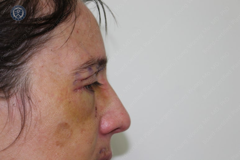 38세 서양 백인 여성, 쌍꺼풀 수술과 눈매교정 및 하안검성형술 (38/F Upper&lower blepharoplasty with levator plication) 관련 이미지 19