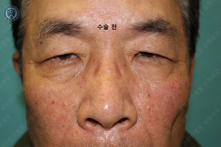67세 남성, 상&middot;하안검성형술 및 안검하수교정 (67/M, Upper &  lower blepharoplasty with ptosis correction) 관련 이미지 16