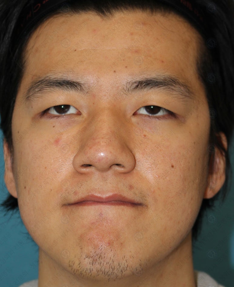 27세 남성 무쌍(속쌍)눈매교정 (27/M Ptosis correction with double lid plasty) 관련 이미지 4