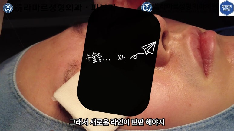 29세 남자, 소시지 쌍꺼풀 두줄따기로 낮추기 (쌍꺼풀 재수술) 관련 이미지 37