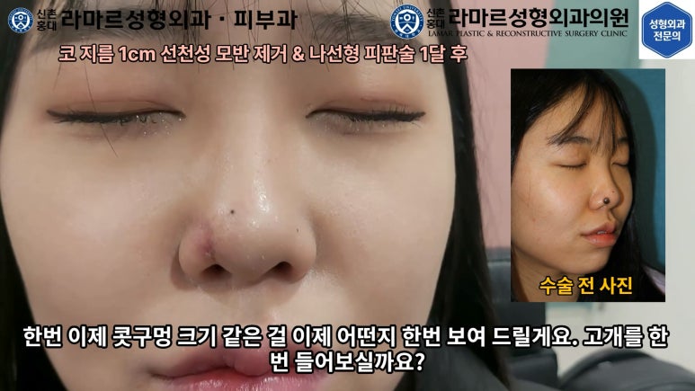 지름 1cm 코 점 제거수술 : 나선피판술(Spiral Flap) 수술전~1달 경과. (Feat. 턱끝필러+사각턱 보톡스) 관련 이미지 156