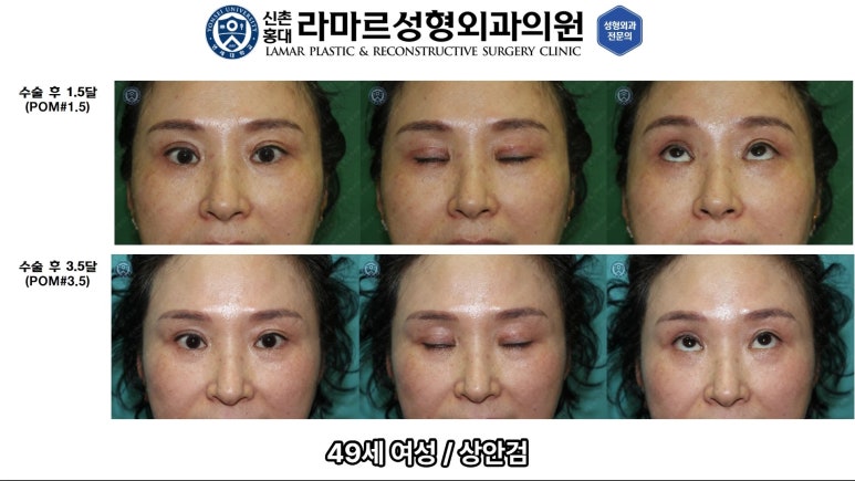 40대~80대 눈 수술 케이스 : 상안검성형술 전후 사진 모음 관련 이미지 11