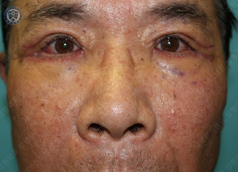 67세 남성, 상&middot;하안검성형술 및 안검하수교정 (67/M, Upper &  lower blepharoplasty with ptosis correction) 관련 이미지 21