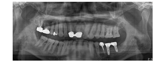 57세 남성, 얼굴 전체골절(57/M Panfacial bone fracture) 수술 및 흉터관리 증례 관련 이미지 6