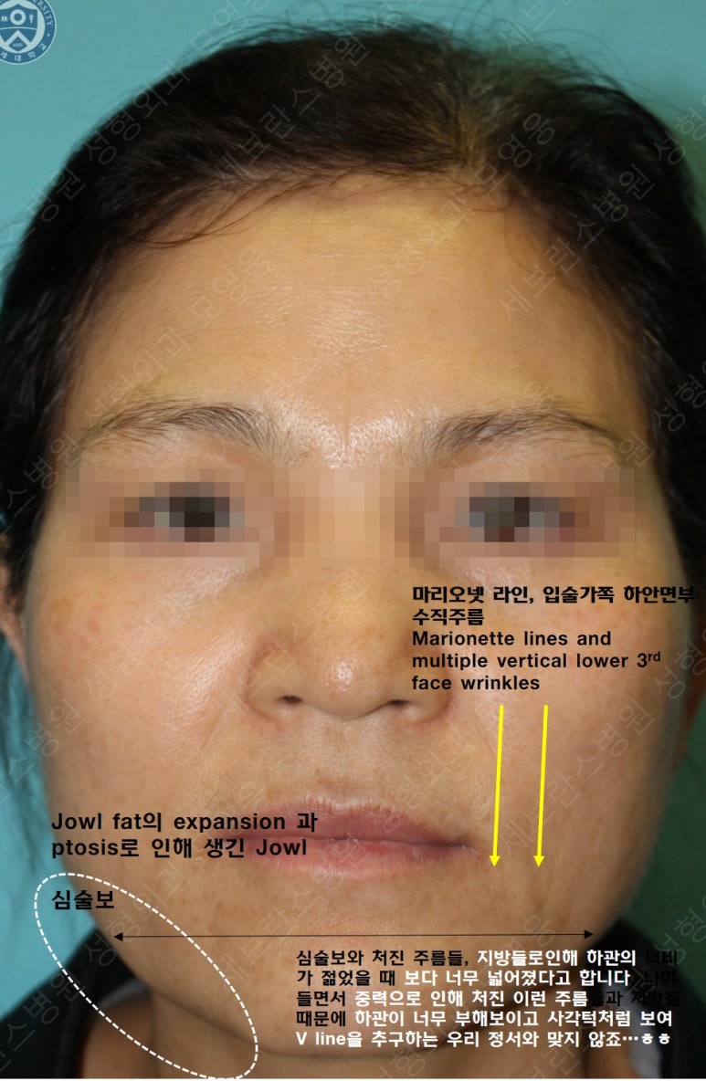 55세 여성, 이중평면 안면거상(55/F, Dual-plane full facelift) 관련 이미지 15