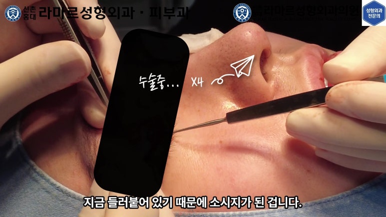 29세 남자, 소시지 쌍꺼풀 두줄따기로 낮추기 (쌍꺼풀 재수술) 관련 이미지 31