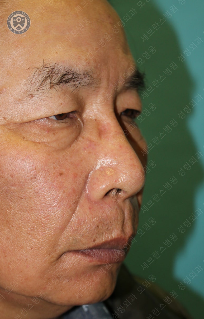 67세 남성, 상&middot;하안검성형술 및 안검하수교정 (67/M, Upper &  lower blepharoplasty with ptosis correction) 관련 이미지 6