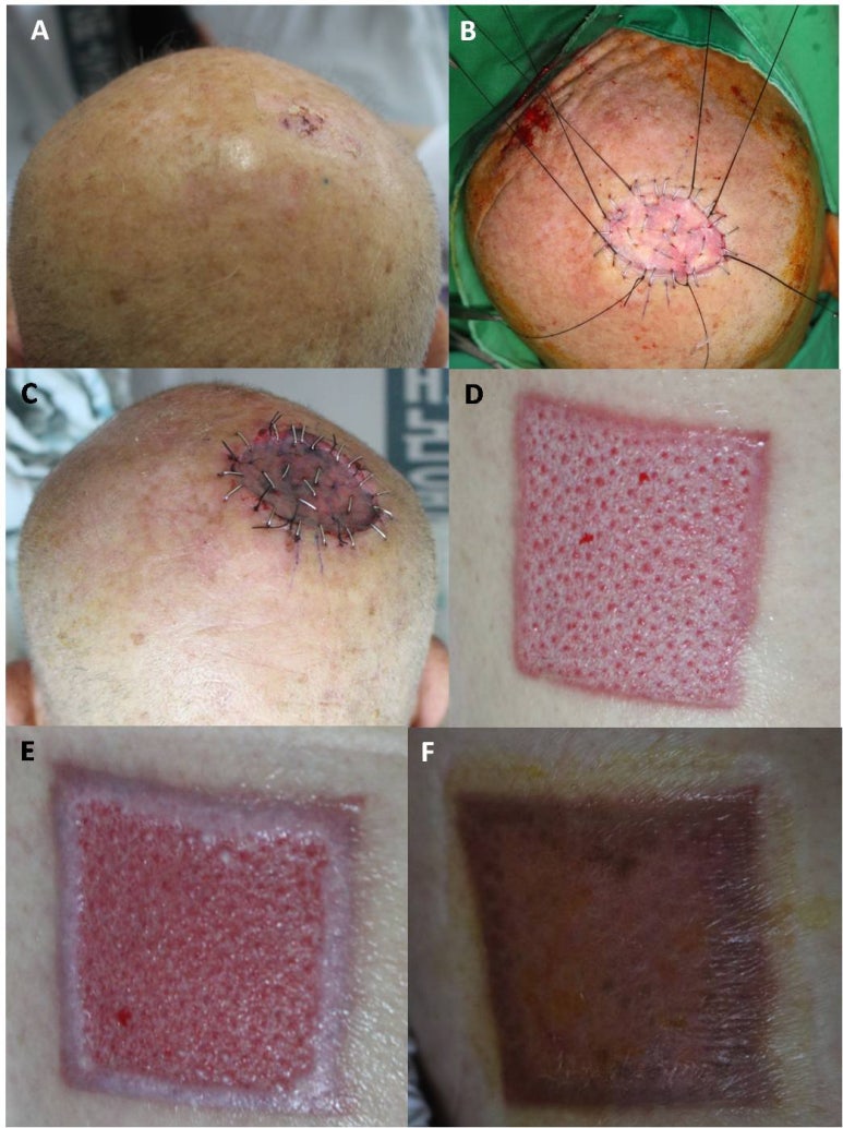 Medicine - Comparison of the recurrence rate of 3 treatmentmodalities for BD in an aging city 관련 이미지 13