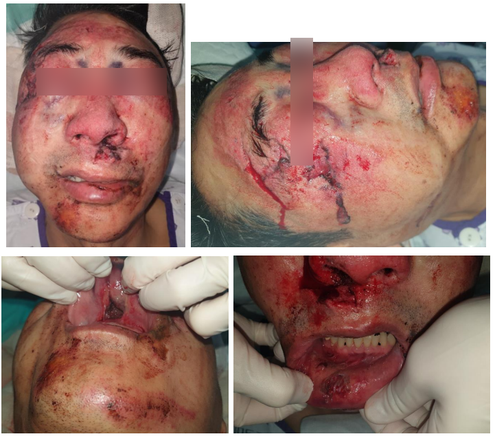 57세 남성, 얼굴 전체골절(57/M Panfacial bone fracture) 수술 및 흉터관리 증례 관련 이미지 2