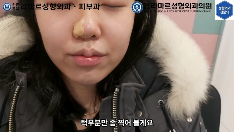 지름 1cm 코 점 제거수술 : 나선피판술(Spiral Flap) 수술전~1달 경과. (Feat. 턱끝필러+사각턱 보톡스) 관련 이미지 111