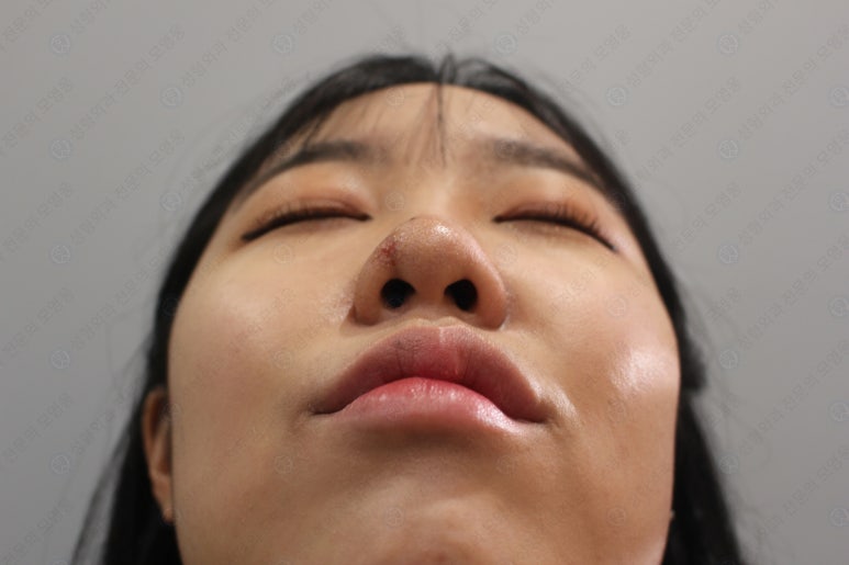 지름 1cm 코 점 제거수술 : 나선피판술(Spiral Flap) 수술전~1달 경과. (Feat. 턱끝필러+사각턱 보톡스) 관련 이미지 115