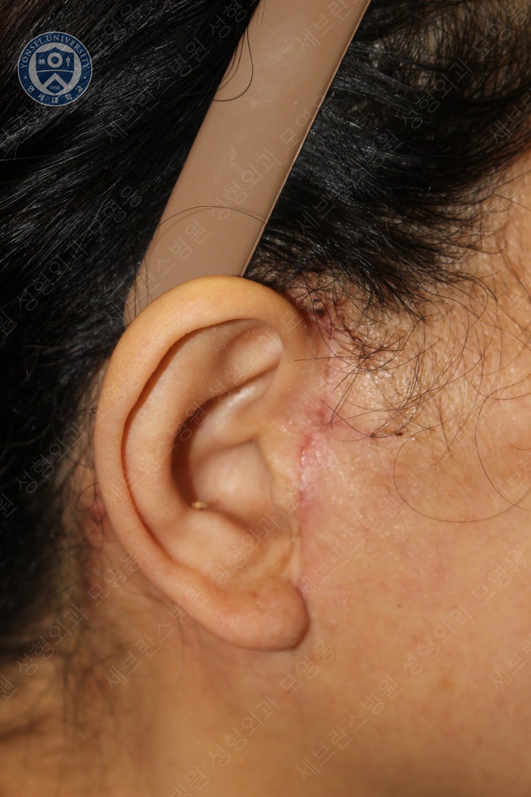 55세 여성, 이중평면 안면거상(55/F, Dual-plane full facelift) 관련 이미지 44