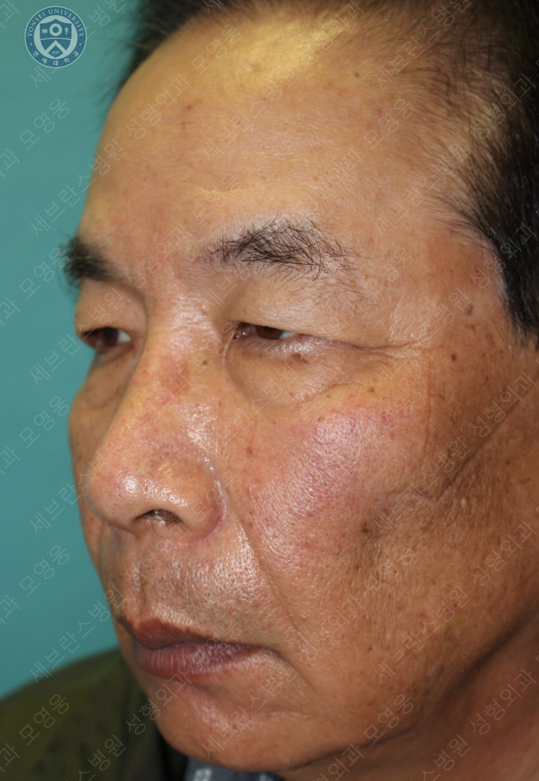 67세 남성, 상&middot;하안검성형술 및 안검하수교정 (67/M, Upper &  lower blepharoplasty with ptosis correction) 관련 이미지 5