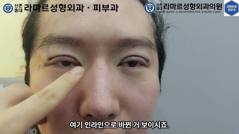 29세 남자, 소시지 쌍꺼풀 두줄따기로 낮추기 (쌍꺼풀 재수술) 관련 이미지 60