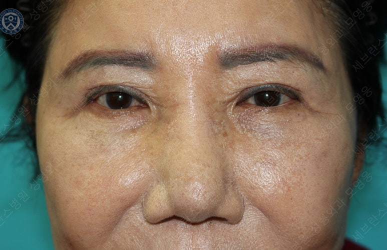 71세 여성, 이마거상술과 이마축소술 (71/F, Forehead lift and reduction) 관련 이미지 41