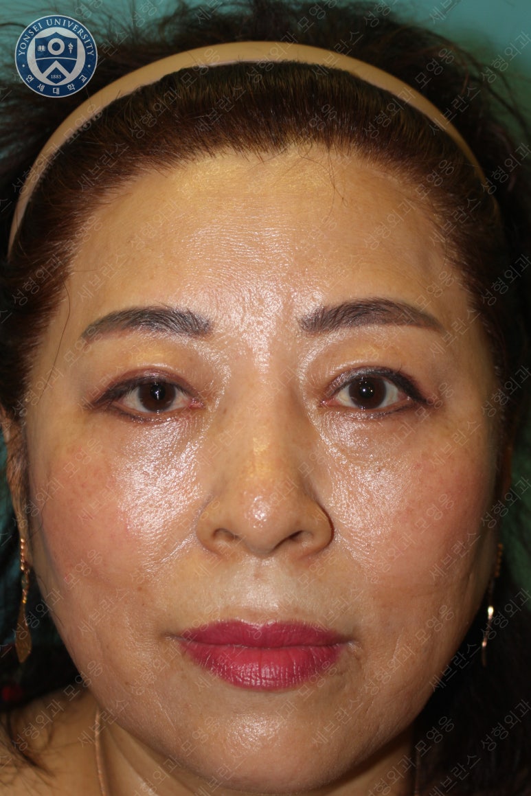 60세 여성, 상안검 및 하안검 성형술 증례 (60/F Upper & lower blepharoplasty) 관련 이미지 22