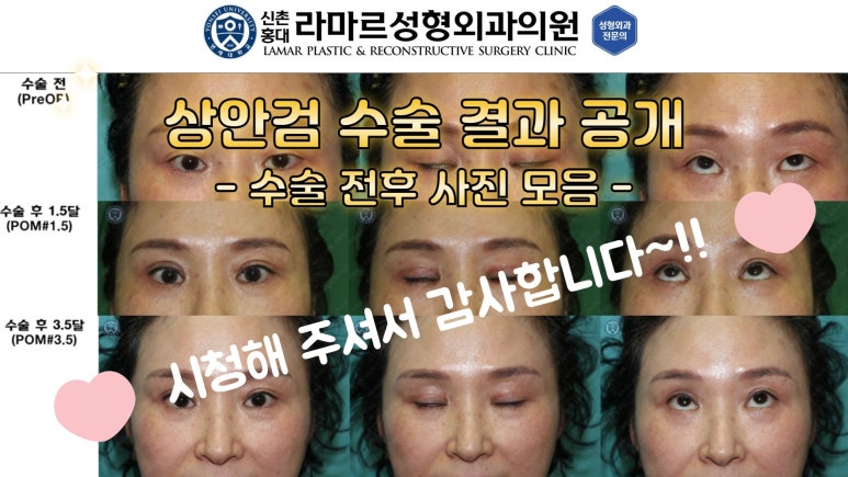 40대~80대 눈 수술 케이스 : 상안검성형술 전후 사진 모음 관련 이미지 32