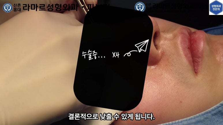 29세 남자, 소시지 쌍꺼풀 두줄따기로 낮추기 (쌍꺼풀 재수술) 관련 이미지 38