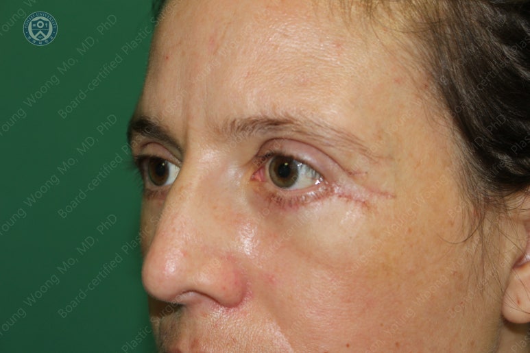 38세 서양 백인 여성, 쌍꺼풀 수술과 눈매교정 및 하안검성형술 (38/F Upper&lower blepharoplasty with levator plication) 관련 이미지 26