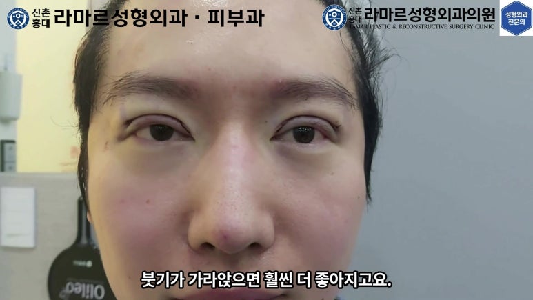 29세 남자, 소시지 쌍꺼풀 두줄따기로 낮추기 (쌍꺼풀 재수술) 관련 이미지 76