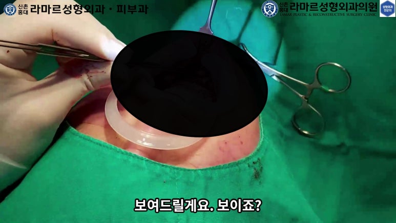 파라핀 필러 입 안 절개로 흉터없이 빼내기! 관련 이미지 75