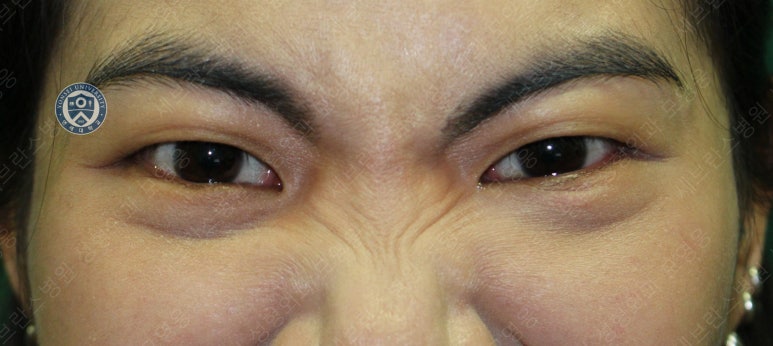 28세 여성, 눈밑지방재배치(눈밑지, 28/F Transconjunctival septal fat redraping-internal fixation technique) 관련 이미지 22