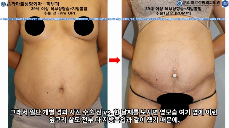 '복부성형술+지방흡입(Abdominoplasty+PAL)' 으로 뱃살 끝장내기! 관련 이미지 52