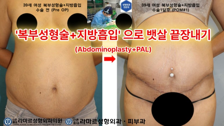'복부성형술+지방흡입(Abdominoplasty+PAL)' 으로 뱃살 끝장내기! 관련 이미지 5