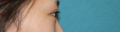 17세 여성, 쌍꺼풀+앞트임(DEO+Medial epicanthoplasty) 관련 이미지 37