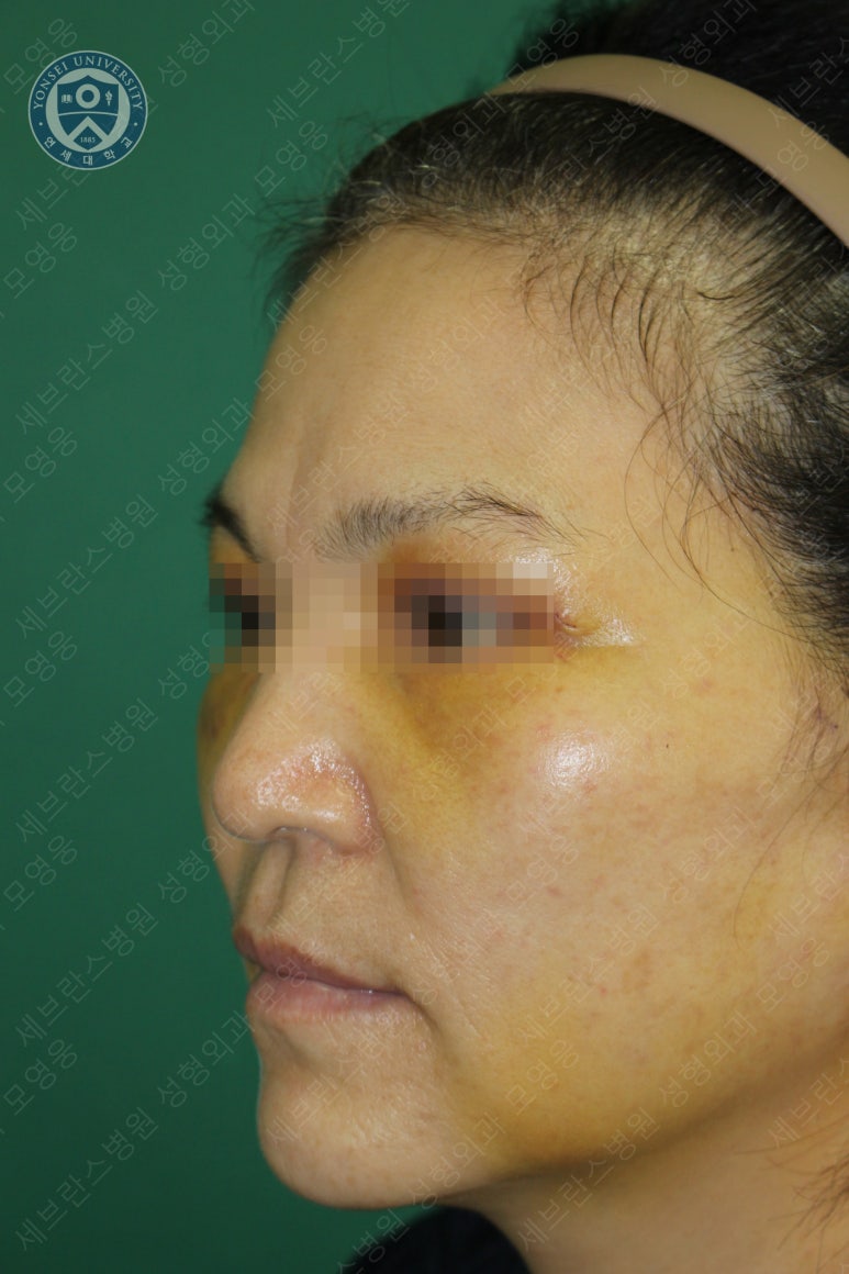 55세 여성, 이중평면 안면거상(55/F, Dual-plane full facelift) 관련 이미지 19