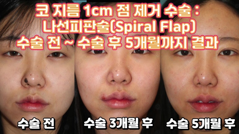 21세 여성 코 지름 1cm 점 제거수술 : 나선피판술(Spiral Flap) 수술전~5달 경과. (+쌍꺼풀수술, 코필러) 관련 이미지 5