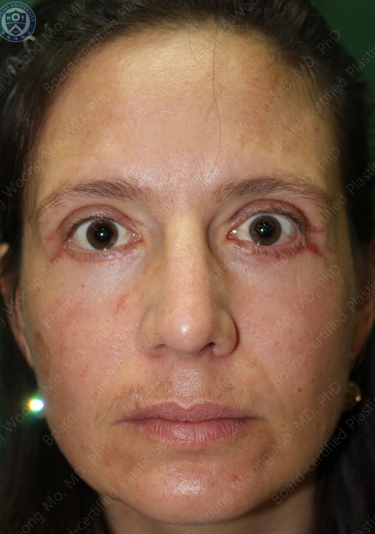 38세 서양 백인 여성, 쌍꺼풀 수술과 눈매교정 및 하안검성형술 (38/F Upper&lower blepharoplasty with levator plication) 관련 이미지 29