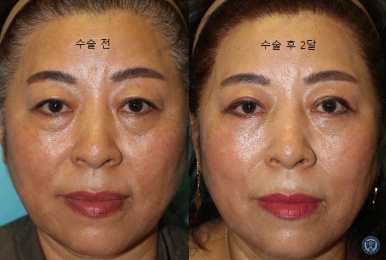 60세 여성, 상안검 및 하안검 성형술 증례 (60/F Upper & lower blepharoplasty) 관련 이미지 30