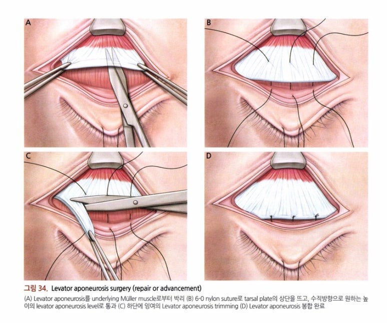 남자눈성형: 무쌍눈매교정 (Blephroptosis correction-levator aponeurosis advancement) 관련 이미지 19